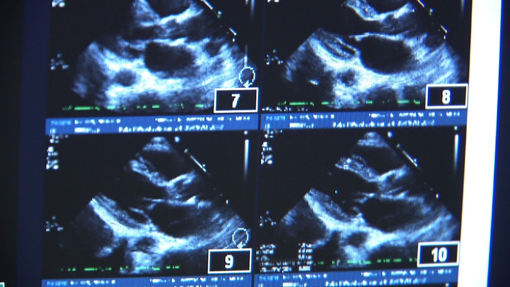Knowing the Signs of Heart Disease in Women