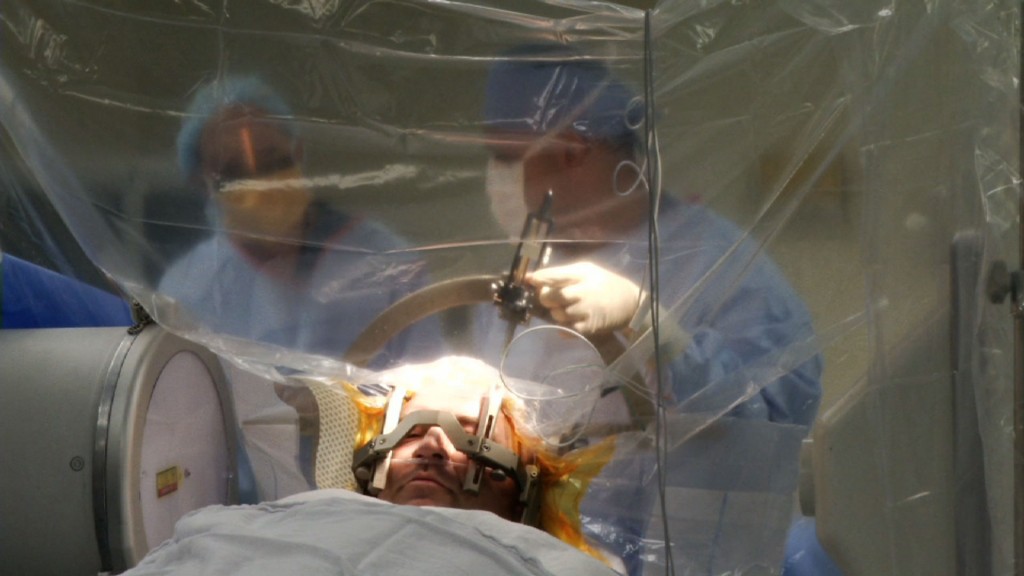 Using Deep Brain Stimulation Surgery to Help Ease Parkinson’s Symptoms