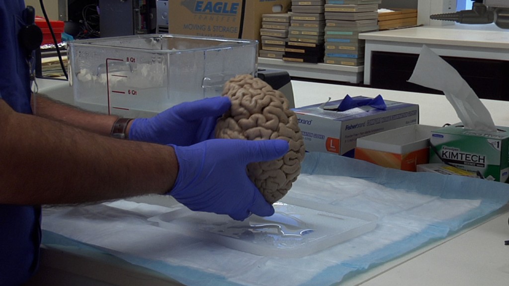 Researchers Want More Donated Brains to Study Autism