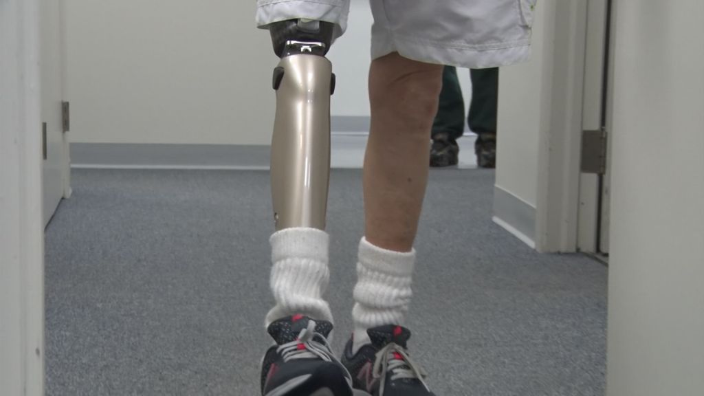Prosthetics tech gap costs money and lives according to report