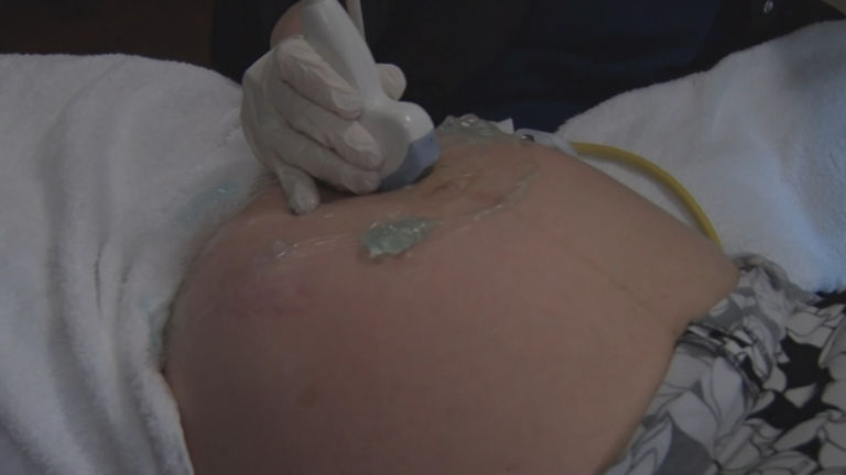 NJ has reduced its c-section rate, but is it low enough?