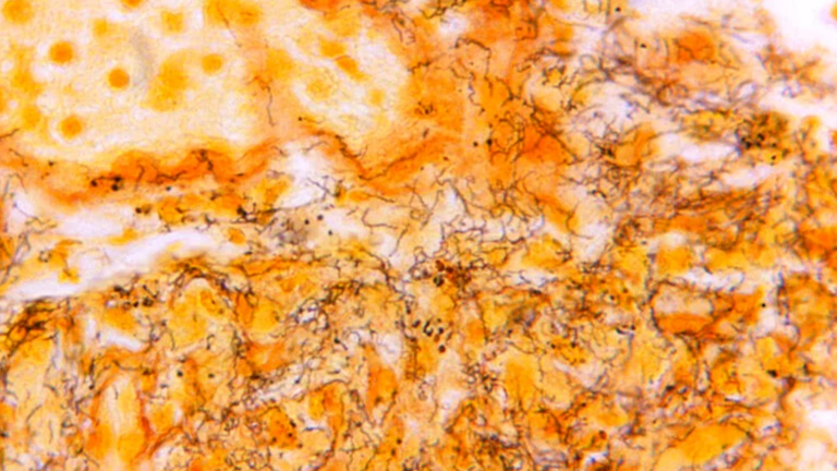 Syphilis cases rising sharply in Pennsylvania, New Jersey and Delaware, new data shows